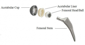 Hip Joint Prosthesis