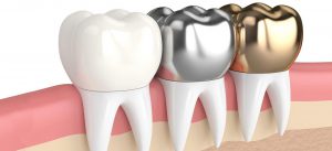 Different Types of Dental Crown