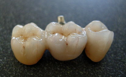 Comparison of zirconia ceramic teeth and metal ceramic teeth